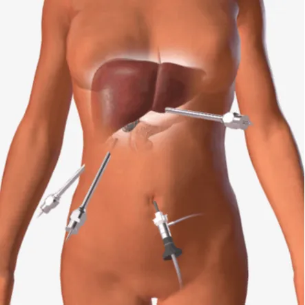 Λαπαροσκοπική χολοκυστεκτομή - Gallbladder Laparoscopy