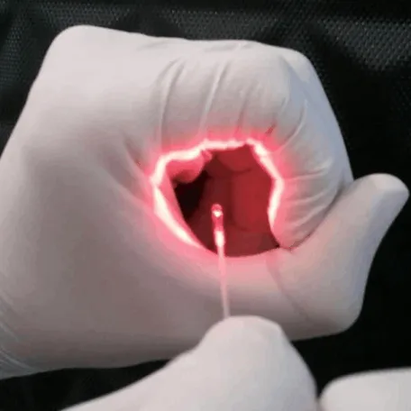 Λέιζερ Αιμορροϊδες, Συρίγγιο, Κόκκυγας -  laser hemorrhoids fistula pilonidal